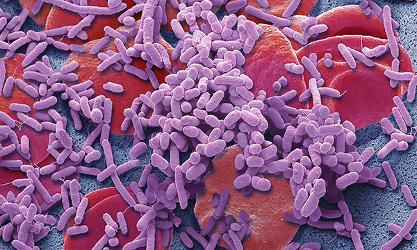 Sepsis