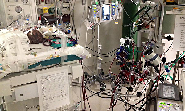 ECMO