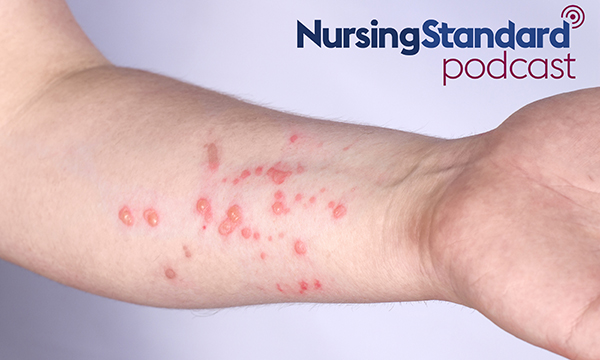 Monkeypox rash on skin