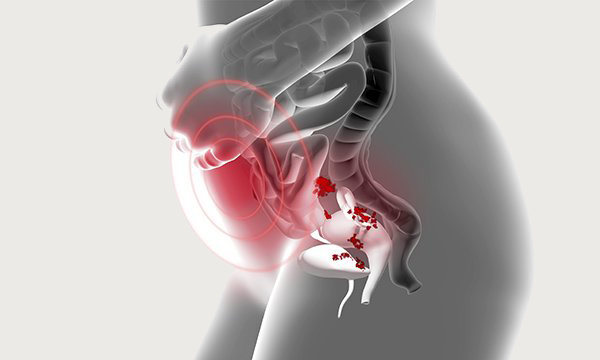 Endometriosis