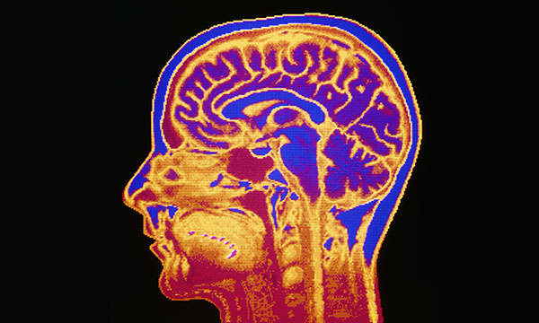 Brain cancer