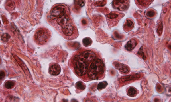 Hodgkin's lymphoma