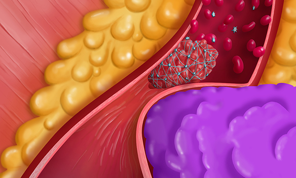 Cancer_arterial_thrombosis,_drawing_-SPL.jpg