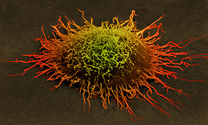 Cervical cancer cell