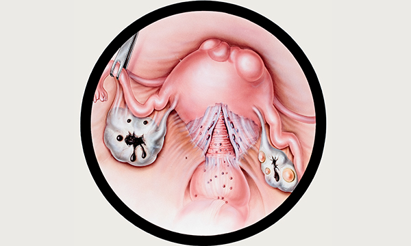 Endometriosis