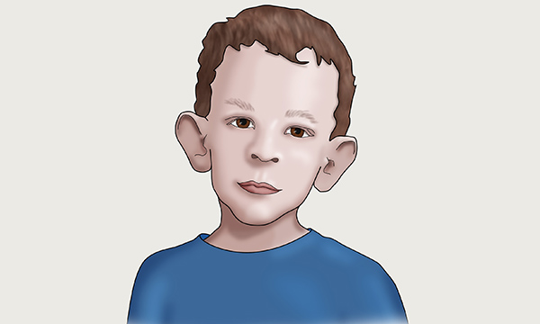 Fragile X syndrome