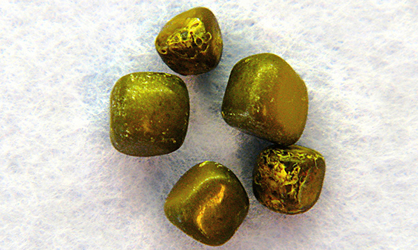 Gallstones