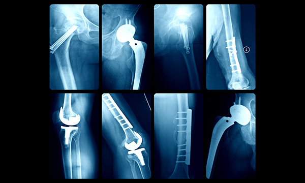 hip fracture 