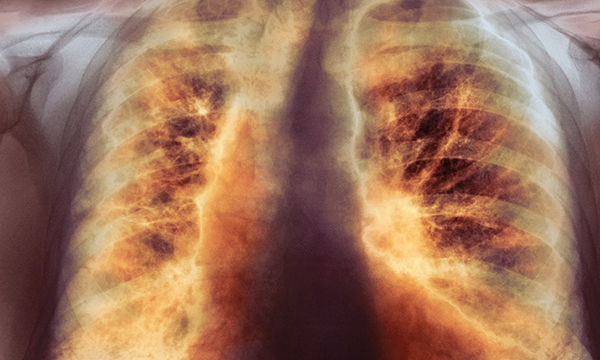 lung scarring