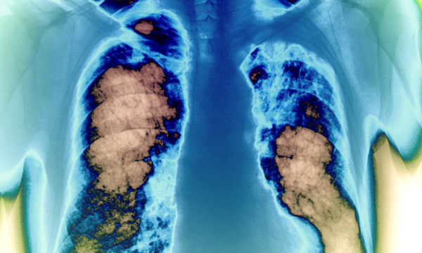 Mesothelioma