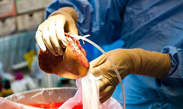 Organ donation