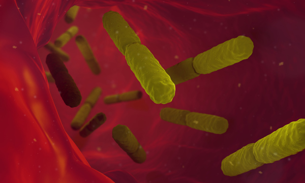 Sepsis