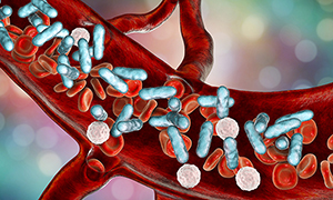 Sepsis