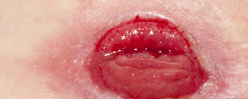 Stoma