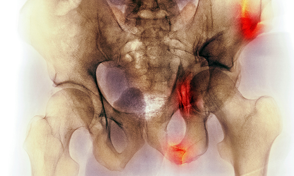 Tile_C0021022_Fractured_pelvis_SPL.jpg