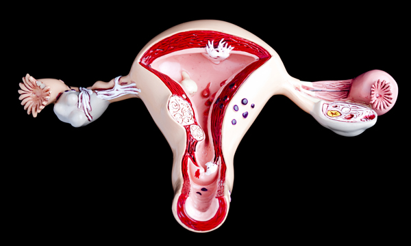 Womb cancer