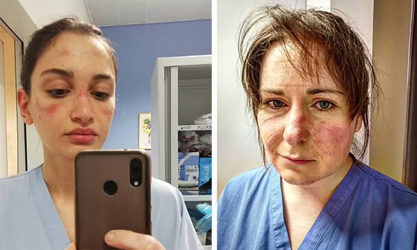 Skin damage caused by PPE