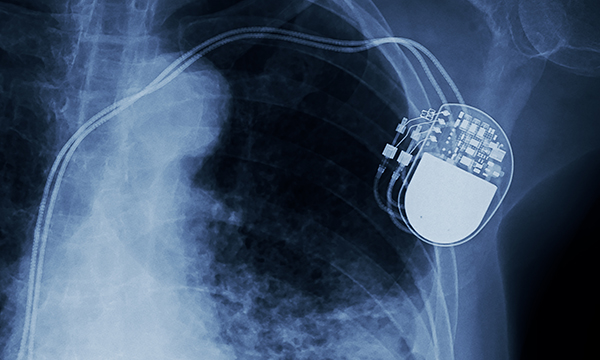Cardiac pacing: principles, interventions and patient support