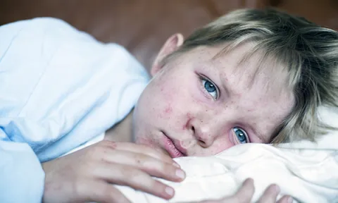 Measles