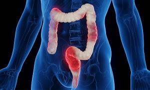 Immunotherapy-induced diarrhoea and colitis: a case study of its management in a nurse-led cancer treatment unit