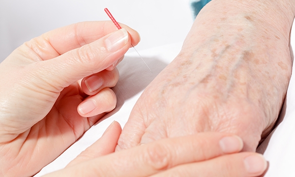 Accupuncture