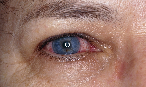 Acute iritis