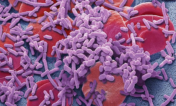 Sepsis