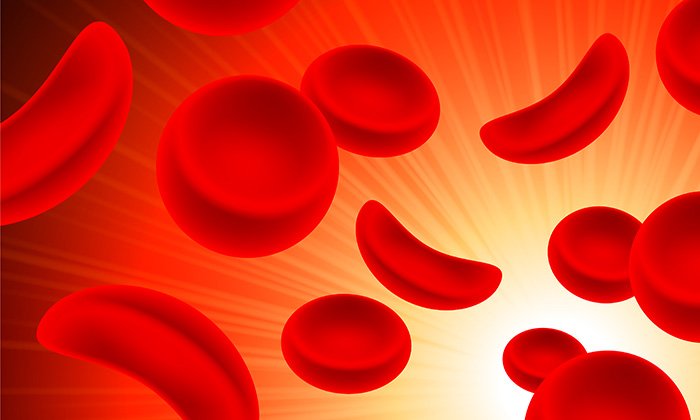 Sickle cell disease