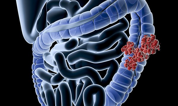 Bowel cancer