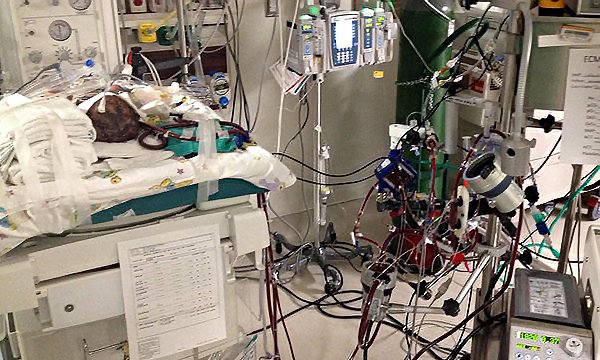 ECMO