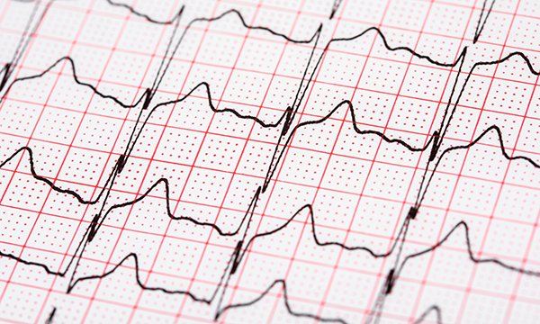Atrial Fibrilation
