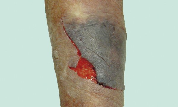 Skin tear