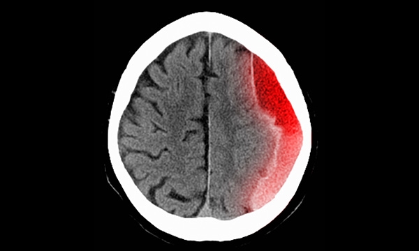 Brain injury
