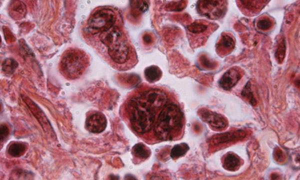 Hodgkin's lymphoma