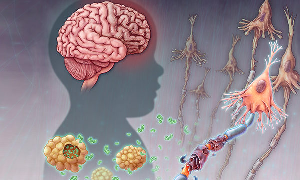 Tay-sachs disease