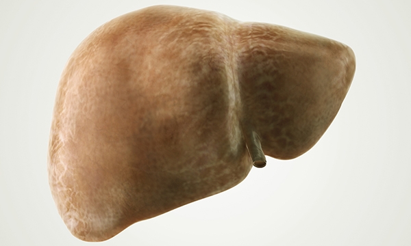 Fatty liver