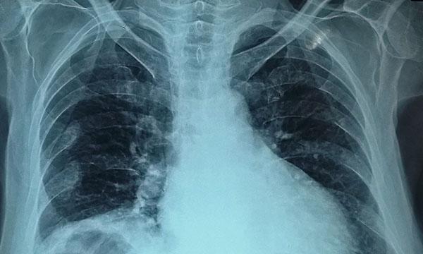Chilaiditi syndrome