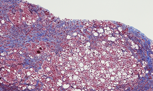 Cirrhosis