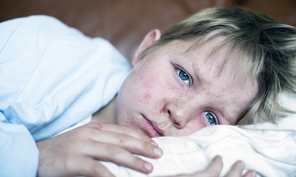 Measles