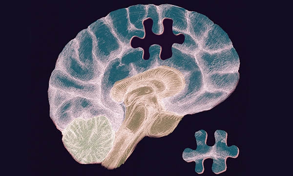 Dementia