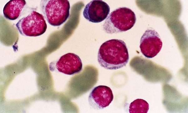 Myeloma