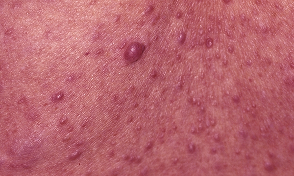 Neurofibromatosis