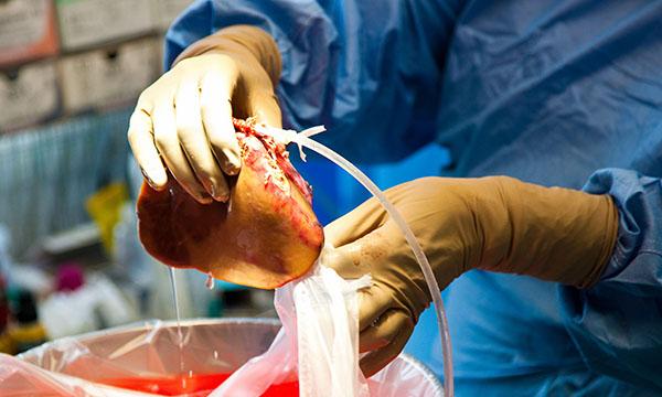 Organ donation