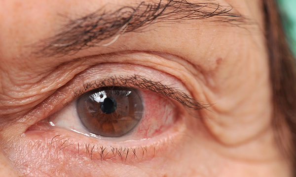 Red eye