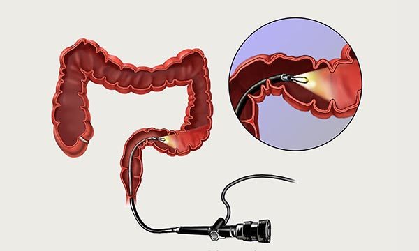 Sigmoidoscope-Alamy.jpg