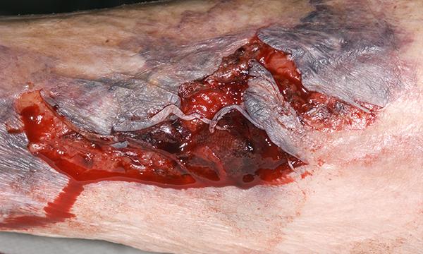 Skin tears