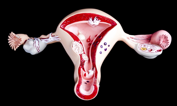 Womb cancer